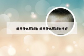 癣用什么可以治 癣用什么可以治疗好