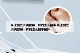 身上到处长类似癣一样的怎么回事 身上到处长类似癣一样的怎么回事图片