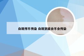 白斑传不传染 白斑到底会不会传染