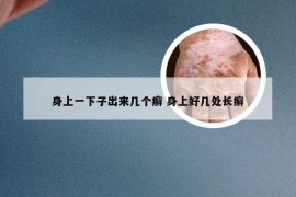 身上一下子出来几个癣 身上好几处长癣