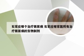 石家庄哪个治疗银屑病 石家庄哪家医院有治疗银屑病的生物制剂