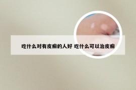 吃什么对有皮癣的人好 吃什么可以治皮癣