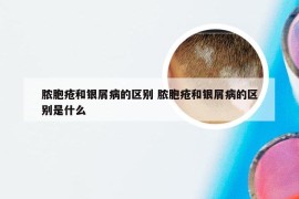 脓胞疮和银屑病的区别 脓胞疮和银屑病的区别是什么