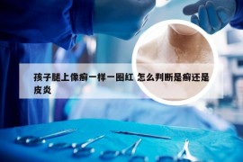 孩子腿上像癣一样一圈红 怎么判断是癣还是皮炎