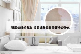 银屑病科学备孕 银屑病备孕前需要检查什么