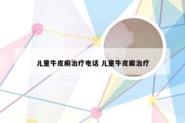 儿童牛皮癣治疗电话 儿童牛皮廨治疗