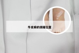 牛皮癣的拔罐位置