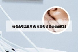 梅毒会引发银屑病 梅毒和银屑病病症区别