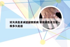 好大夫色素减退副银屑病 银屑病色素沉着一般多久能退
