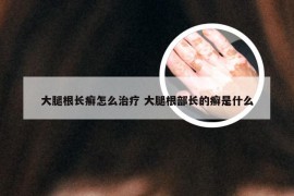 大腿根长癣怎么治疗 大腿根部长的癣是什么