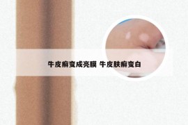 牛皮癣变成亮膜 牛皮肤癣变白
