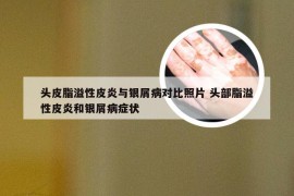 头皮脂溢性皮炎与银屑病对比照片 头部脂溢性皮炎和银屑病症状