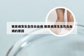银屑病发生急性白血病 银屑病发生急性白血病的原因