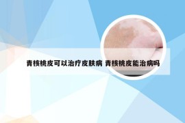 青核桃皮可以治疗皮肤病 青核桃皮能治病吗