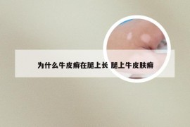 为什么牛皮癣在腿上长 腿上牛皮肤癣