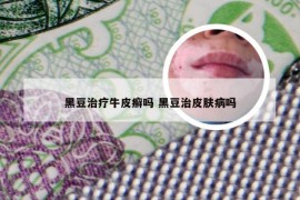 黑豆治疗牛皮癣吗 黑豆治皮肤病吗