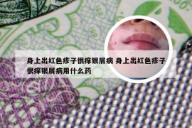 身上出红色疹子很痒银屑病 身上出红色疹子很痒银屑病用什么药