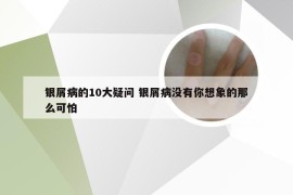 银屑病的10大疑问 银屑病没有你想象的那么可怕