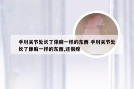 手肘关节处长了像癣一样的东西 手肘关节处长了像癣一样的东西,还很痒