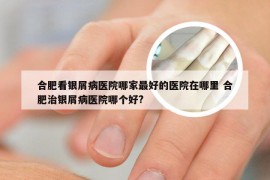 合肥看银屑病医院哪家最好的医院在哪里 合肥治银屑病医院哪个好?