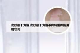 皮肤病干戈烙 皮肤病干戈烙手脚特别痒能用硫软膏