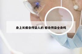 身上长癣会传染人的 癣会传染全身吗