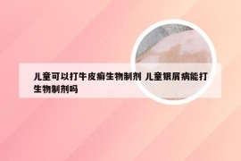 儿童可以打牛皮癣生物制剂 儿童银屑病能打生物制剂吗