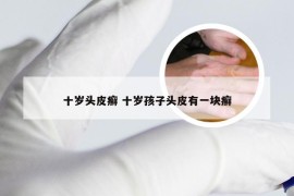 十岁头皮癣 十岁孩子头皮有一块癣