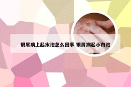 银屑病上起水泡怎么回事 银屑病起小白泡