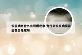银屑病为什么有薄膜现象 为什么银屑病摸着感觉全是疙瘩
