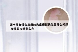 四十多女性头皮癣的头皮痒掉头发是什么问题 女性头皮癣怎么办