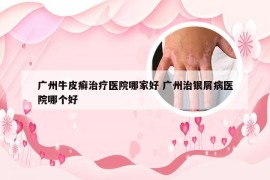 广州牛皮癣治疗医院哪家好 广州治银屑病医院哪个好