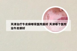 天津治疗牛皮癣哪家医院最好 天津哪个医院治牛皮癖好