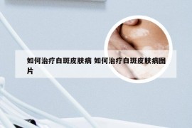 如何治疗白斑皮肤病 如何治疗白斑皮肤病图片