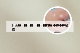 什么癣一圈一圈 一圈一圈的癣 不疼不痒起皮