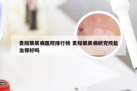 贵阳银屑病医院排行榜 贵阳银屑病研究院能治得好吗