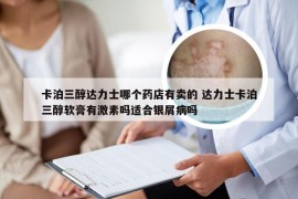 卡泊三醇达力士哪个药店有卖的 达力士卡泊三醇软膏有激素吗适合银屑病吗