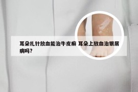 耳朵扎针放血能治牛皮癣 耳朵上放血治银屑病吗?