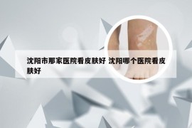 沈阳市那家医院看皮肤好 沈阳哪个医院看皮肤好