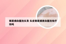 银屑病白醋洗头发 头皮银屑病用白醋洗有疗效吗