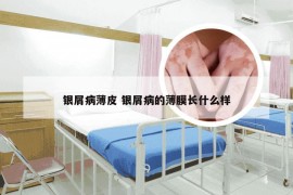 银屑病薄皮 银屑病的薄膜长什么样
