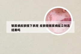 银屑病皮肤镜下表现 皮肤镜银屑病能立刻出结果吗