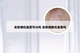 皮肤病吃韭菜可以吗 皮肤病敢吃韭菜吗