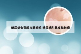 糖尿病会引起皮肤癣吗 糖尿病引起皮肤长癣