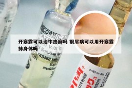 开塞露可以治牛皮癣吗 银屑病可以用开塞露抹身体吗