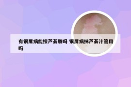 有银屑病能擦芦荟胶吗 银屑病抹芦荟汁管用吗