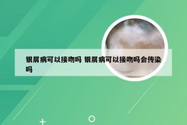 银屑病可以接吻吗 银屑病可以接吻吗会传染吗