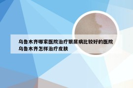 乌鲁木齐哪家医院治疗银屑病比较好的医院 乌鲁木齐怎样治疗皮肤