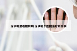 深圳哪里看银屑病 深圳哪个医院治疗银屑病
