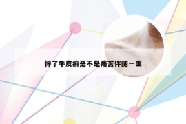 得了牛皮癣是不是痛苦伴随一生